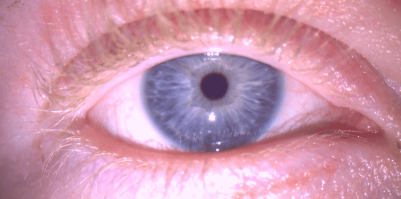 Cirugía láser para el nistagmo