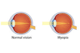 Myopia Control